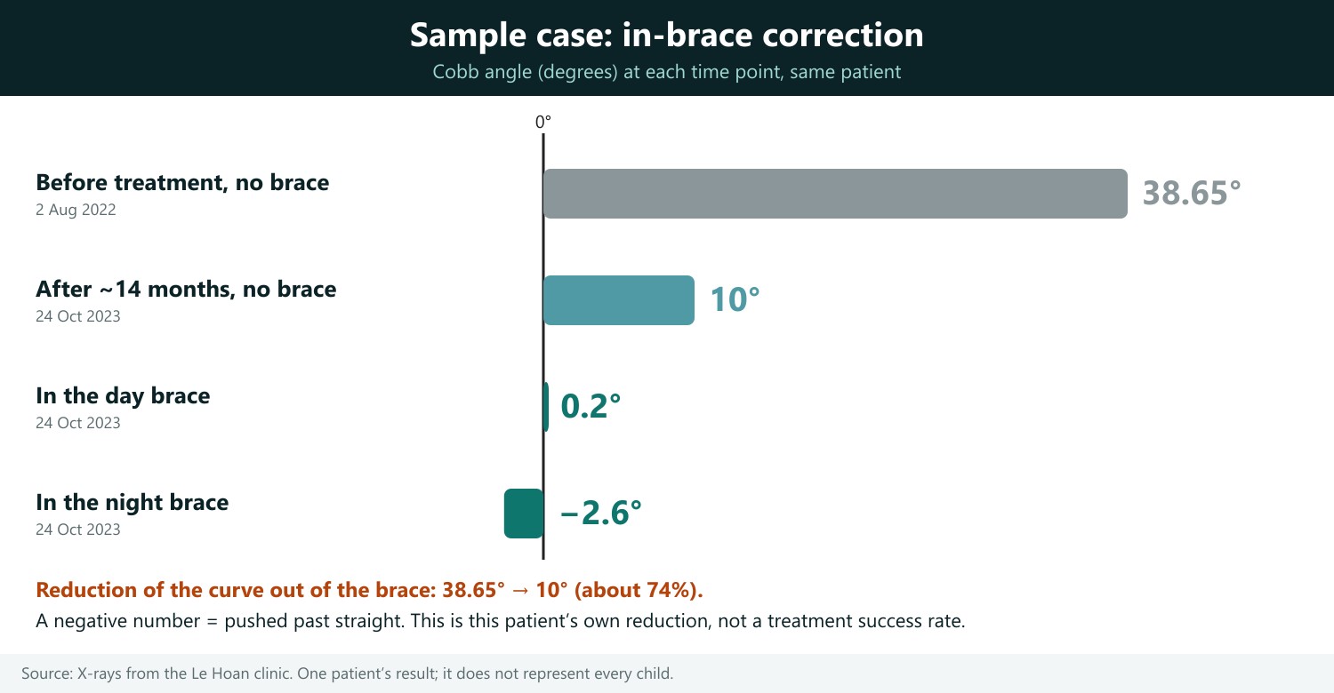 How to read: each horizontal bar is the Cobb angle of the same patient at one time point; the shorter the bar, the straighter the curve, and a bar to the left of the 0° line is a curve pushed past straight to the opposite side. From 38.65° before treatment, the angle was 10° out of the brace after about 14 months (down about 74%), 0.2° in the day brace and −2.6° in the night brace. Figures come from the clinic’s X-rays; the link between in-brace correction and outcome is reported in the reviews of van den Bogaart (2019), Emans (1986) and Katz (2010).