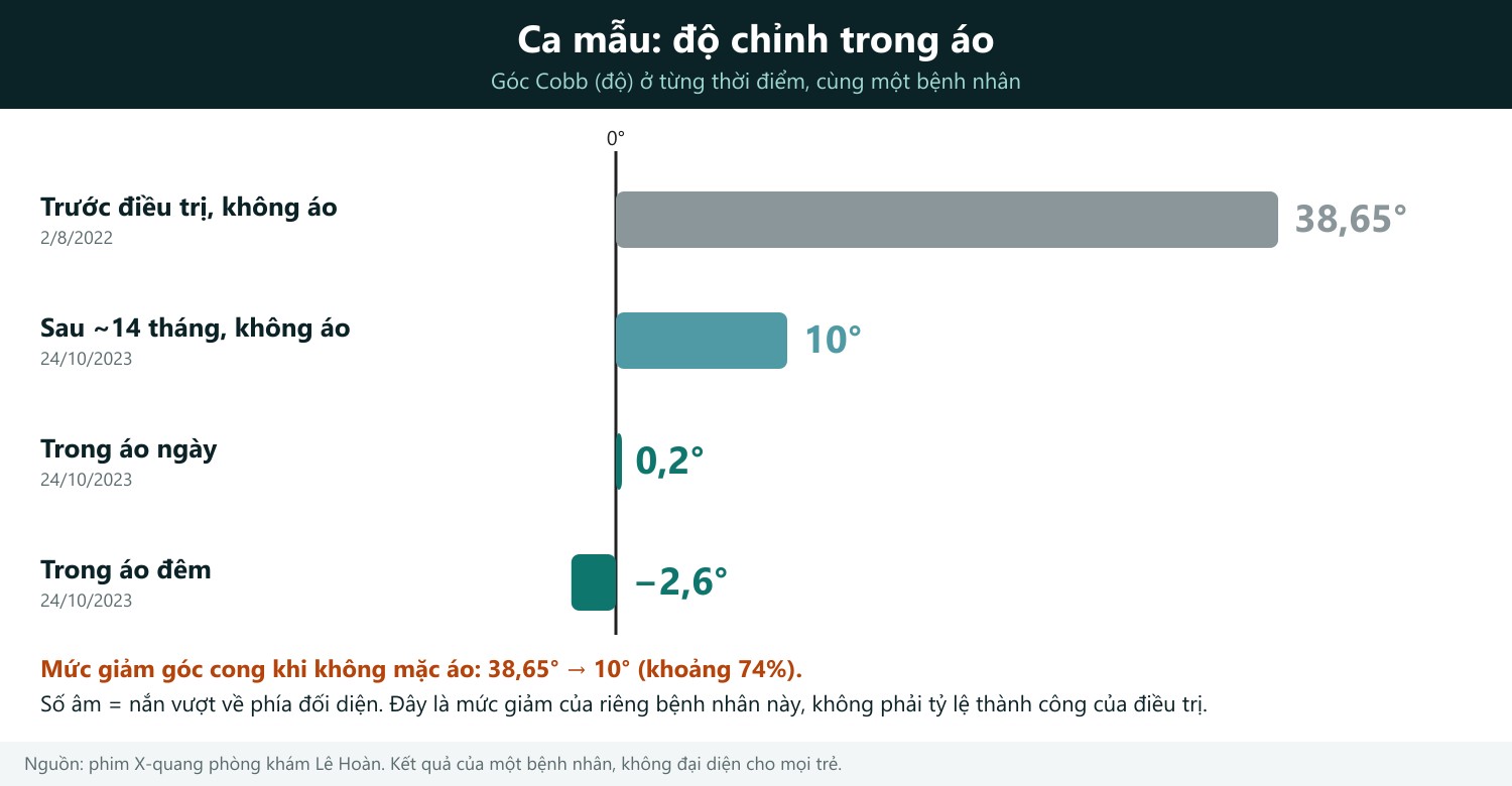 Cách đọc hình: mỗi thanh ngang là góc Cobb của cùng một bệnh nhân ở một thời điểm; thanh càng ngắn thì đường cong càng thẳng, thanh nằm bên trái vạch 0° là đường cong được nắn vượt sang phía đối diện. Từ 38,65° khi chưa điều trị, góc còn 10° khi không mặc áo sau khoảng 14 tháng (giảm khoảng 74%), còn 0,2° trong áo ngày và −2,6° trong áo đêm. Số liệu từ phim X-quang của phòng khám; mối liên quan giữa độ chỉnh trong áo và kết quả được nêu ở tổng quan van den Bogaart (2019), Emans (1986) và Katz (2010).