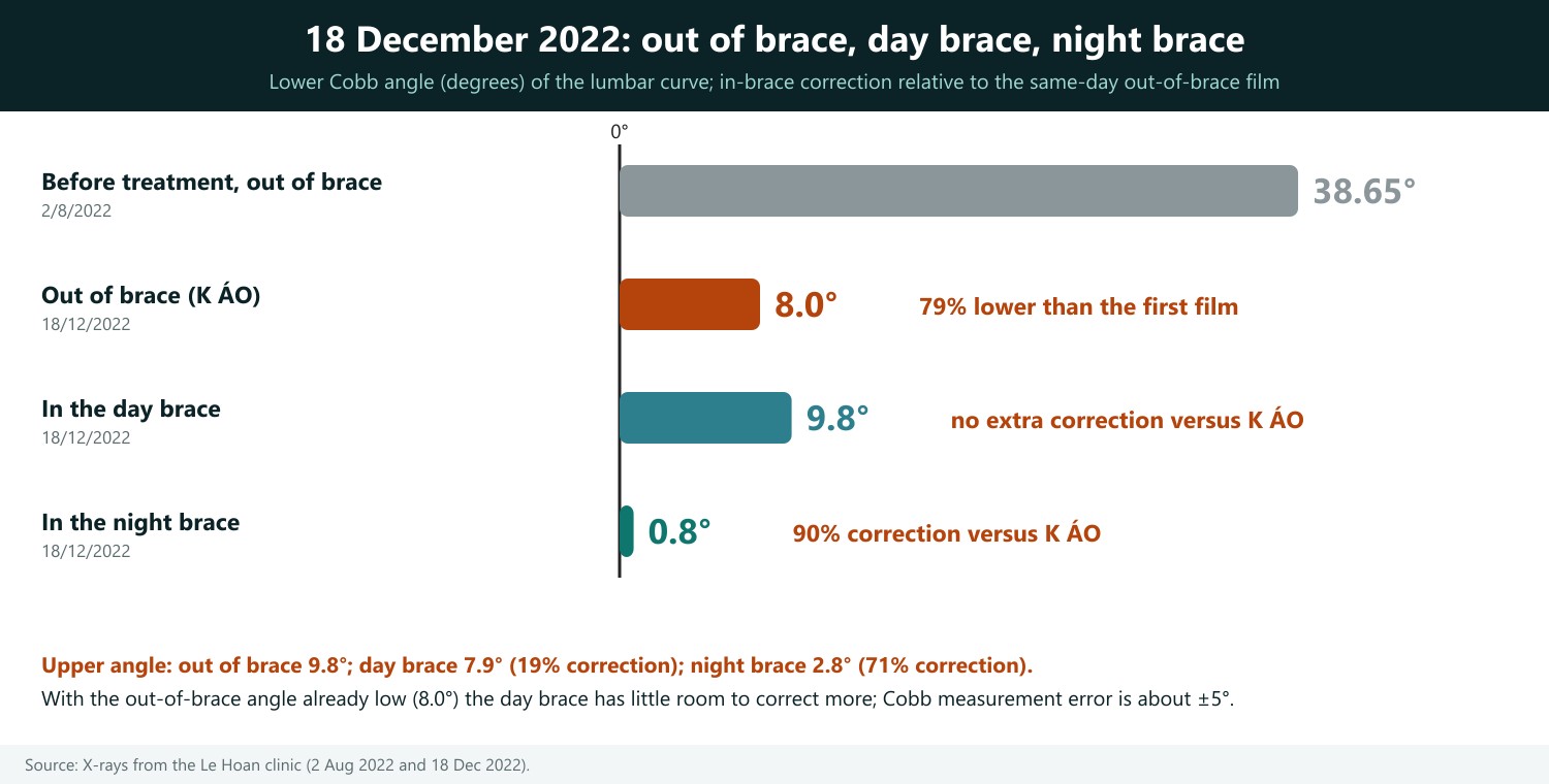 How to read: each horizontal bar is the Cobb angle of the same patient. The grey bar is the initial out-of-brace film (38.65°). The two green bars are the films taken at the very first fitting (18 December 2022): day brace 9.8° (about 75% lower than 38.65°) and night brace 0.8° (about 98% lower). The shorter the bar, the straighter the curve. This is in-brace correction, the same kind of figure as the Boston study (Emans, average about 50%), not a rate of avoiding surgery.