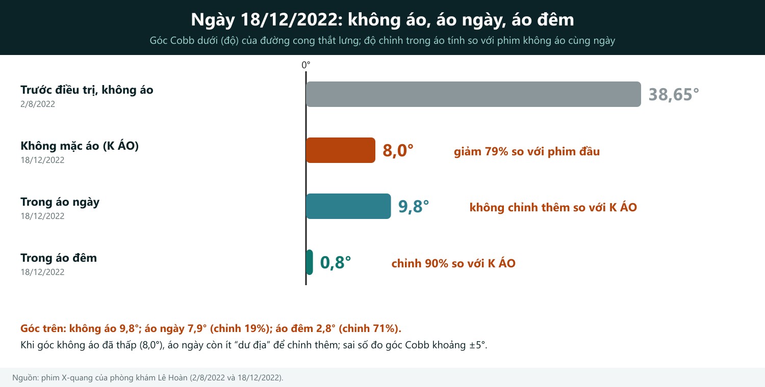Cách đọc hình: mỗi thanh ngang là góc Cobb của cùng một bệnh nhân. Thanh xám là phim không áo ban đầu (38,65°). Hai thanh xanh là hai phim chụp ngay lần đầu mặc áo (18/12/2022): áo ngày 9,8° (giảm khoảng 75% so với 38,65°) và áo đêm 0,8° (giảm khoảng 98%). Thanh càng ngắn thì đường cong càng thẳng. Đây là độ chỉnh trong áo, cùng loại số liệu với nghiên cứu Boston (Emans, trung bình khoảng 50%), không phải tỷ lệ tránh mổ.