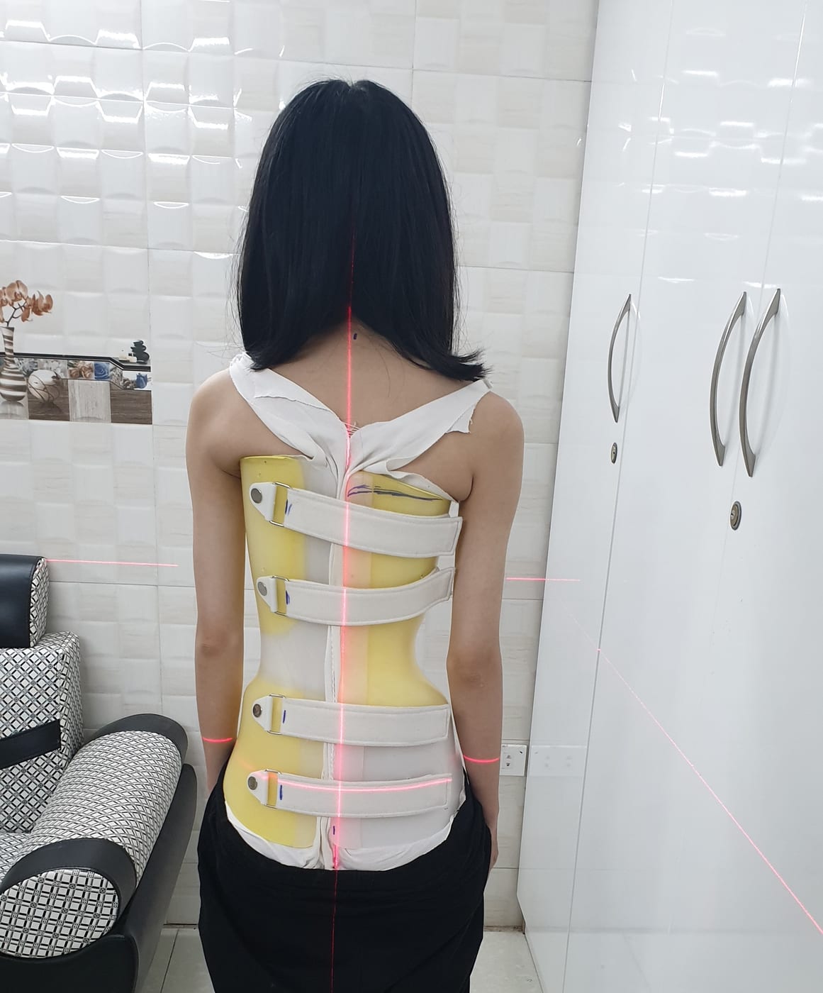 Bệnh nhân mặc áo nẹp cá nhân hóa, nhìn từ phía sau; tia laser đỏ dùng để kiểm tra thân và cột sống có cân đối, thẳng trục hay không khi mặc áo (đánh giá độ chỉnh trong áo).