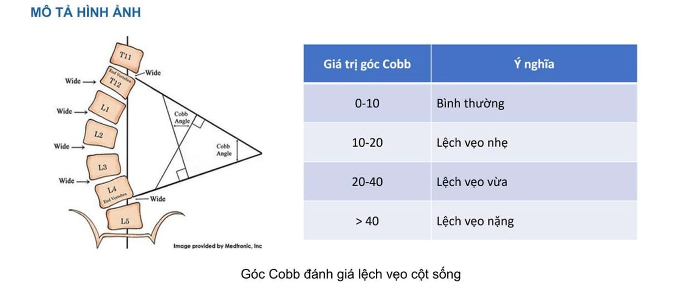 How the Cobb angle is assessed and what each range means (source: dungcuchinhhinh.vn)