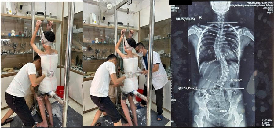 How to read this image: the two photos on the left show plaster casting for a brace at our clinic. The patient stands in a traction frame while the orthotic engineer applies corrective force by hand as the plaster sets, so the curve is already corrected on the mould. On the right is a full-spine X-ray used to measure the Cobb angle and plan the correction. The patient-name line on the film has been masked. Image source: dungcuchinhhinh.vn.