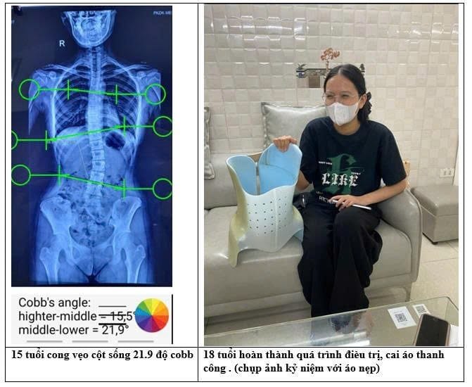 Cách đọc hình: trái là phim X-quang lúc 15 tuổi với hai góc Cobb 15,5° và 21,9° (các đường kẻ xanh là cách đo); phải là ảnh kỷ niệm lúc 18 tuổi, khi đã hoàn thành điều trị và cai áo thành công, bên cạnh chiếc áo nẹp đã dùng. Theo mô tả của phòng khám, sau 2 năm điều trị góc Cobb giảm còn 9°, sau đó mặc duy trì rồi cai áo.