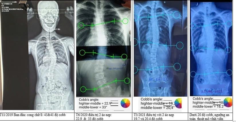 How to read the films: four standing spine X-rays of the same teenager, taken over time from left to right. The green circles and lines are how the Cobb angle is measured on software; the two numbers are the angles of the two curves (upper and lower) of the double S-curve. A Cobb angle of 10° or more counts as scoliosis. Progress: 11/2019 initial 43° and 41° → 6/2020 22.9° and 33° → 3/2021 19.7° and 20.4° → later 18° and 16.2° (below 20°). This is the result of one child and does not represent every child.