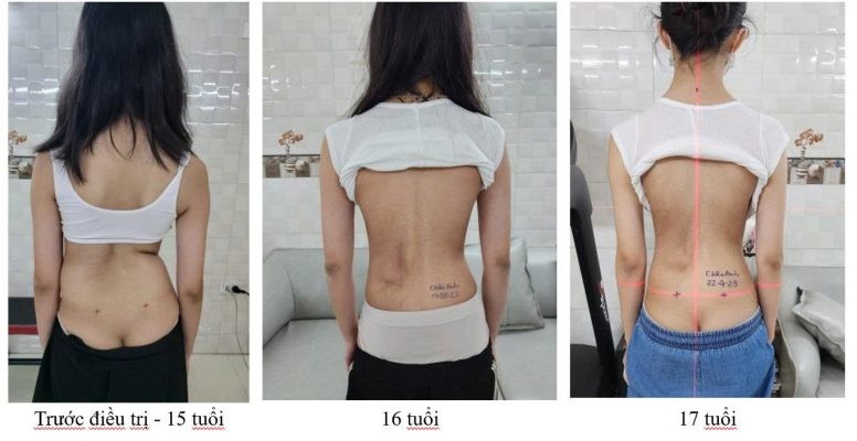 Cách đọc hình: ảnh lưng của cùng bạn nhỏ ở ba thời điểm (trước điều trị, trong quá trình điều trị và về sau). Trước điều trị thân lệch và hai bên eo không đều; về sau lưng cân đối hơn (đường laser đỏ ở ảnh thứ ba dùng làm mốc thẳng đứng và mốc ngang). Ảnh chụp ngoài chỉ để minh họa, không thay thế phim X-quang. Dòng họ tên in trên phim đã được che. Nguồn ảnh: dungcuchinhhinh.vn.