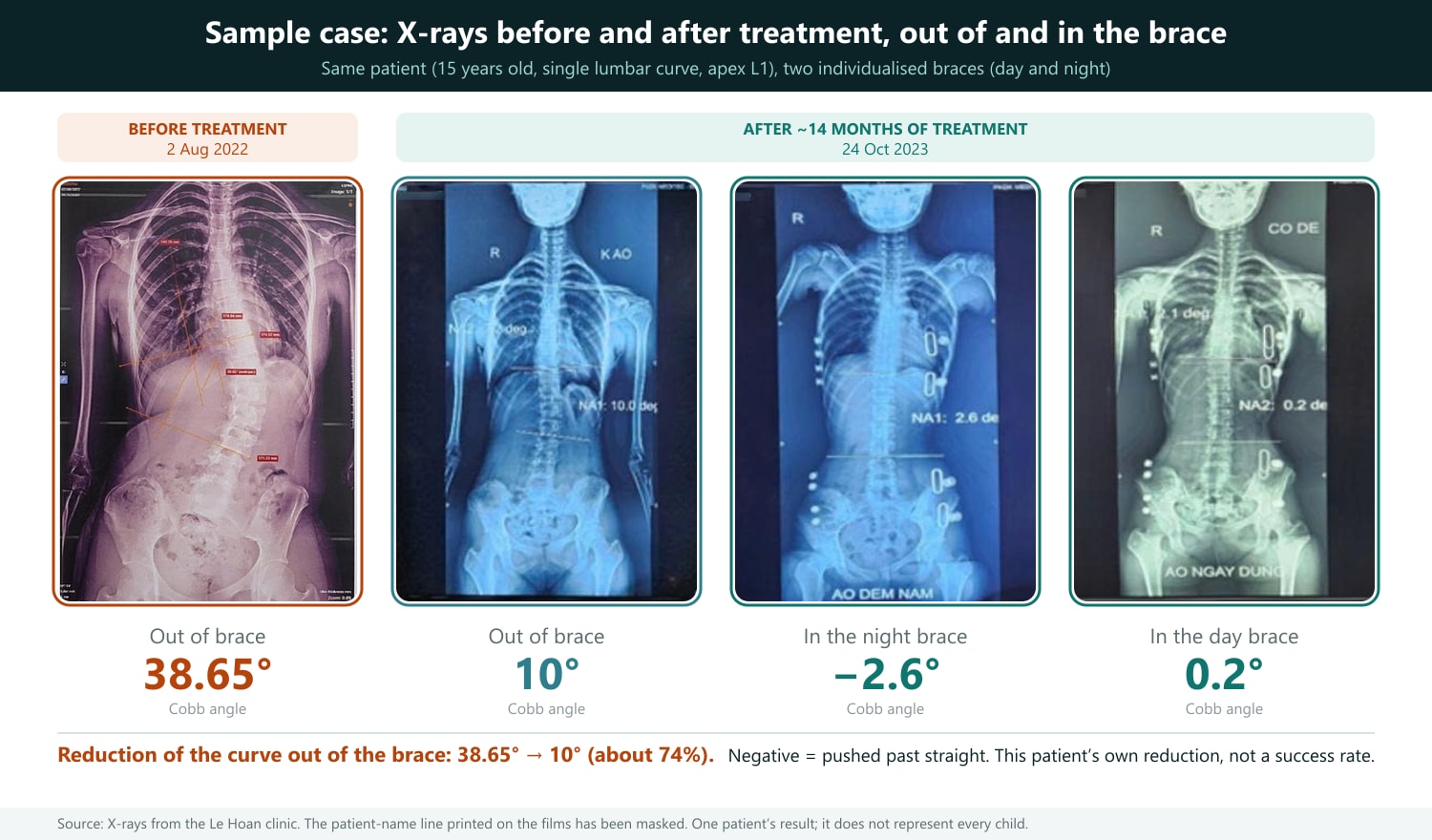 How to read the films: four standing X-rays of the same patient, shown at the same size for easy comparison. The first tile (orange frame) is before treatment (2 August 2022): the orange lines are the Cobb-angle measurement lines, result 38.65°. The other three tiles (green frames) were taken on 24 October 2023, after about 14 months: out of brace (10°), in the night brace (−2.6°, curved to the opposite side) and in the day brace (0.2°); the bright round and elongated objects are the pads and frame of the brace. The large figure under each film is the Cobb angle. The patient-name line printed on the films has been masked; everything else is kept as on the original films. Image source: dungcuchinhhinh.vn.