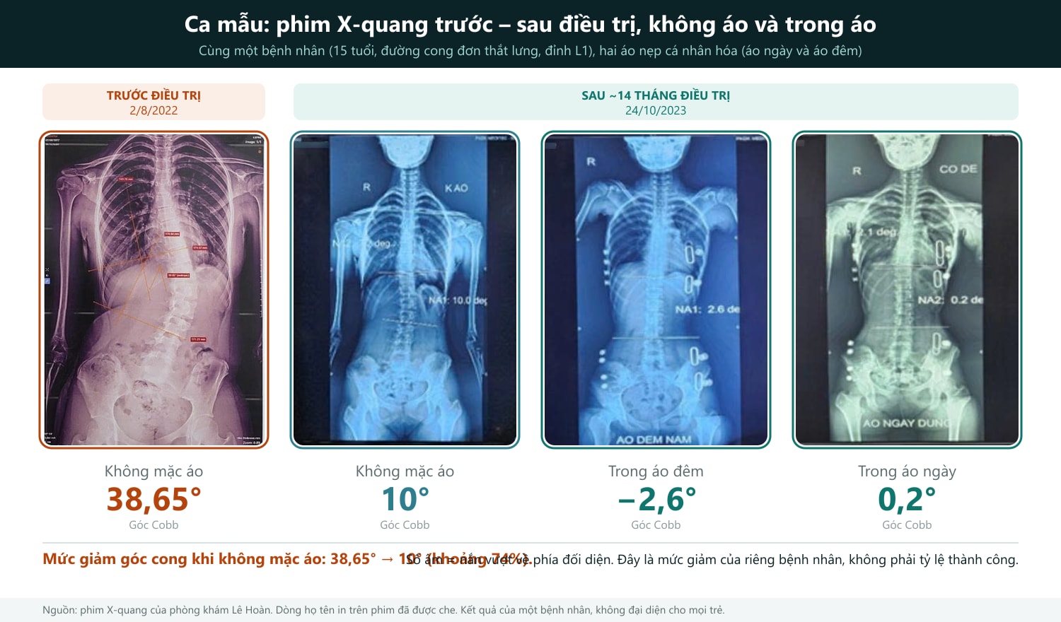 Cách đọc phim: bốn phim X-quang thẳng của cùng một bệnh nhân, cùng kích thước để dễ so sánh. Ô đầu tiên (viền cam) là trước điều trị (2/8/2022): các đường cam là các đường đo góc Cobb, kết quả 38,65°. Ba ô còn lại (viền xanh) chụp ngày 24/10/2023, sau khoảng 14 tháng: không mặc áo (10°), trong áo đêm (−2,6°, cong về phía đối diện) và trong áo ngày (0,2°); những vật tròn, dài sáng trên phim là các miếng đệm và khung của áo. Con số lớn dưới mỗi phim là góc Cobb. Dòng họ tên in trên phim đã được che, các thông tin khác giữ nguyên như phim gốc. Nguồn ảnh: dungcuchinhhinh.vn.