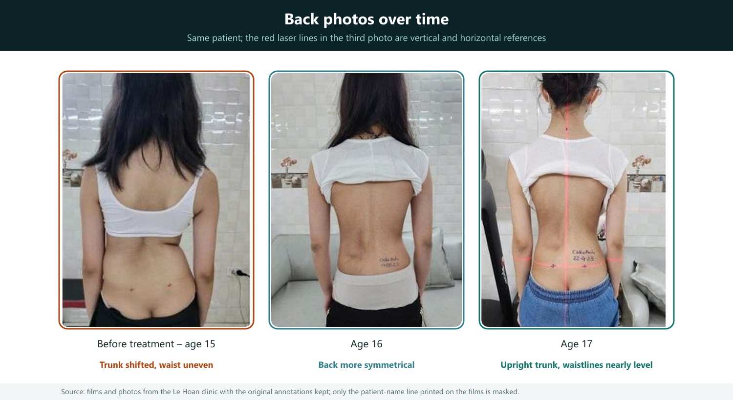 How to read: back photos of the same patient at three time points, age labels as in the original. Before treatment the trunk is shifted and the waistlines uneven; later the back is more symmetrical. The red laser lines in the third photo are vertical and horizontal references; the handwriting on the skin is the clinic’s note. Surface photos only illustrate and do not replace X-rays. Image source: dungcuchinhhinh.vn.