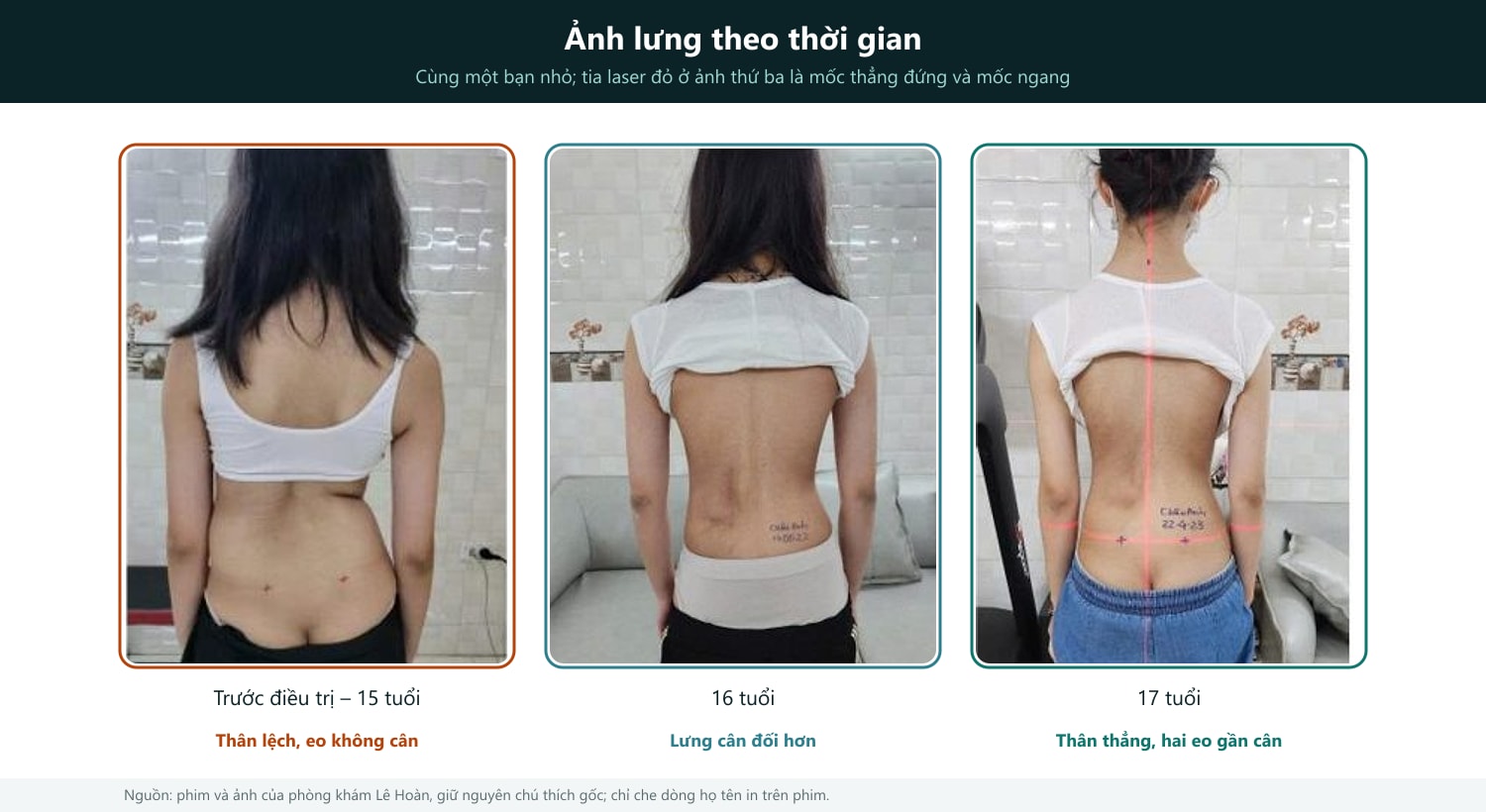 Cách đọc hình: ảnh lưng của cùng một bạn nhỏ ở ba thời điểm, nhãn tuổi theo bản gốc. Trước điều trị thân lệch, hai bên eo không đều; về sau lưng cân đối hơn. Đường laser đỏ ở ảnh thứ ba là mốc thẳng đứng và mốc ngang; chữ viết tay trên da là ghi chú của phòng khám. Ảnh chụp ngoài chỉ để minh họa, không thay thế phim X-quang. Nguồn ảnh: dungcuchinhhinh.vn.