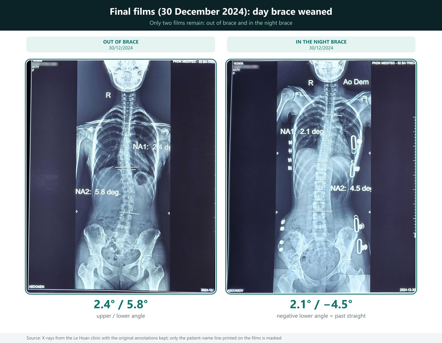 How to read: two films of the same day, 30 December 2024. Left: out of brace, angles 2.4° (upper) and 5.8° (lower). Right: in the night brace (label Ao Dem), 2.1° (upper) and 4.5° at the lower angle; according to the clinic that angle lies toward the opposite side and is therefore recorded as −4.5° (past straight). The day brace had been weaned, so there is no day-brace film. The patient-name line printed on the films has been masked; other annotations are kept.