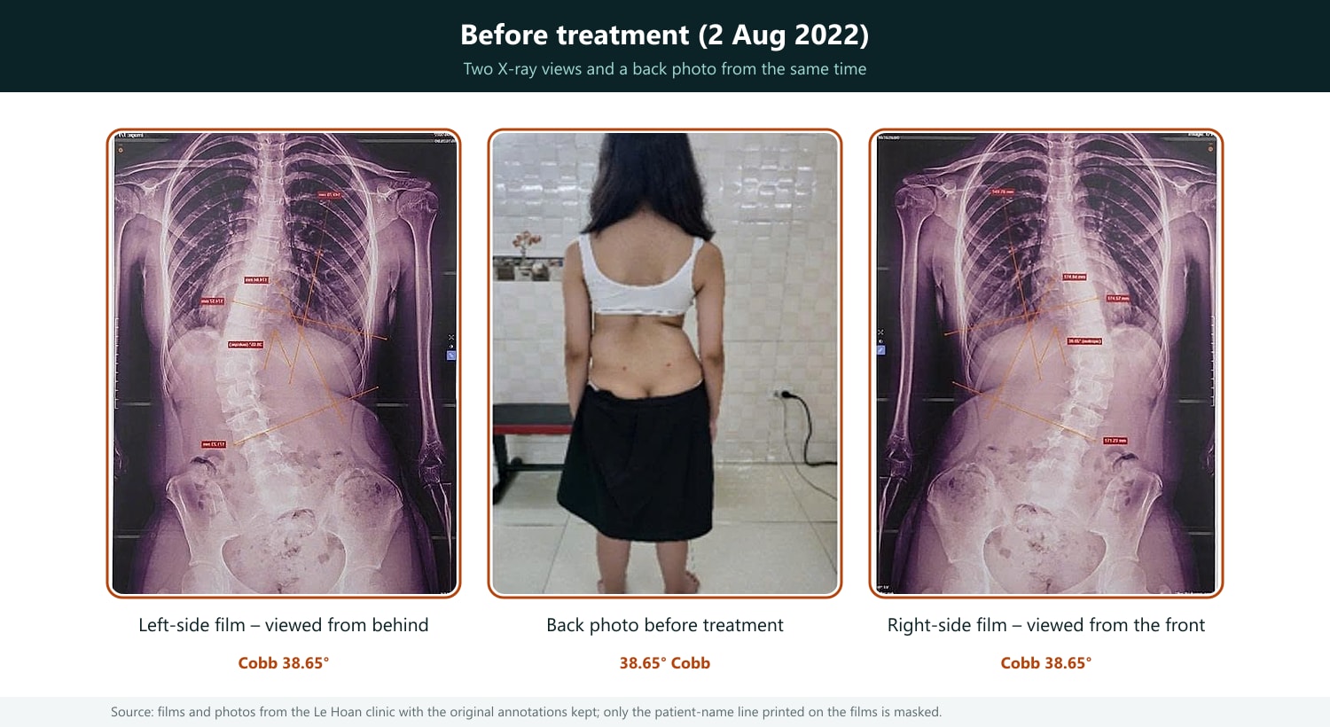 How to read: three tiles of equal size. The two outer tiles are the X-ray of the same examination (left: flipped to look from behind; right: seen from the front), the middle tile is a back photo from the same time. The orange lines and measurement boxes are how the Cobb angle is measured on software, result 38.65°. The patient-name line printed on the films has been masked; other annotations are kept as on the original films. Image source: dungcuchinhhinh.vn.