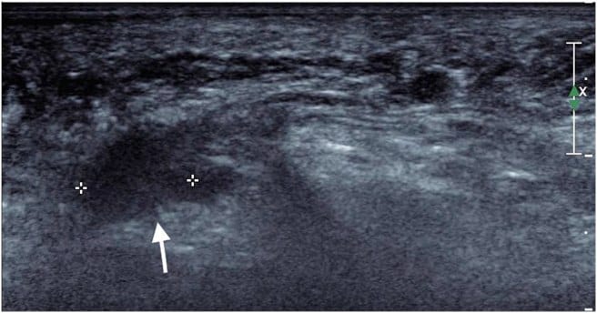 Ultrasound: a hypoechoic mass (arrow) between the metatarsal heads (source: dungcuchinhhinh.vn)