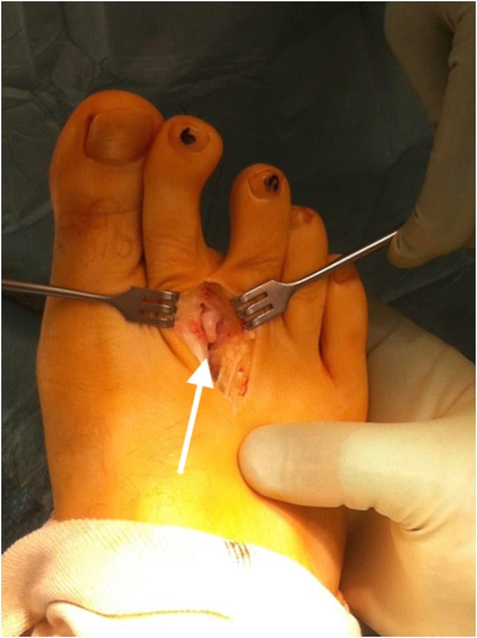 Intra-operative view: Morton’s neuroma (arrow) (source: dungcuchinhhinh.vn)