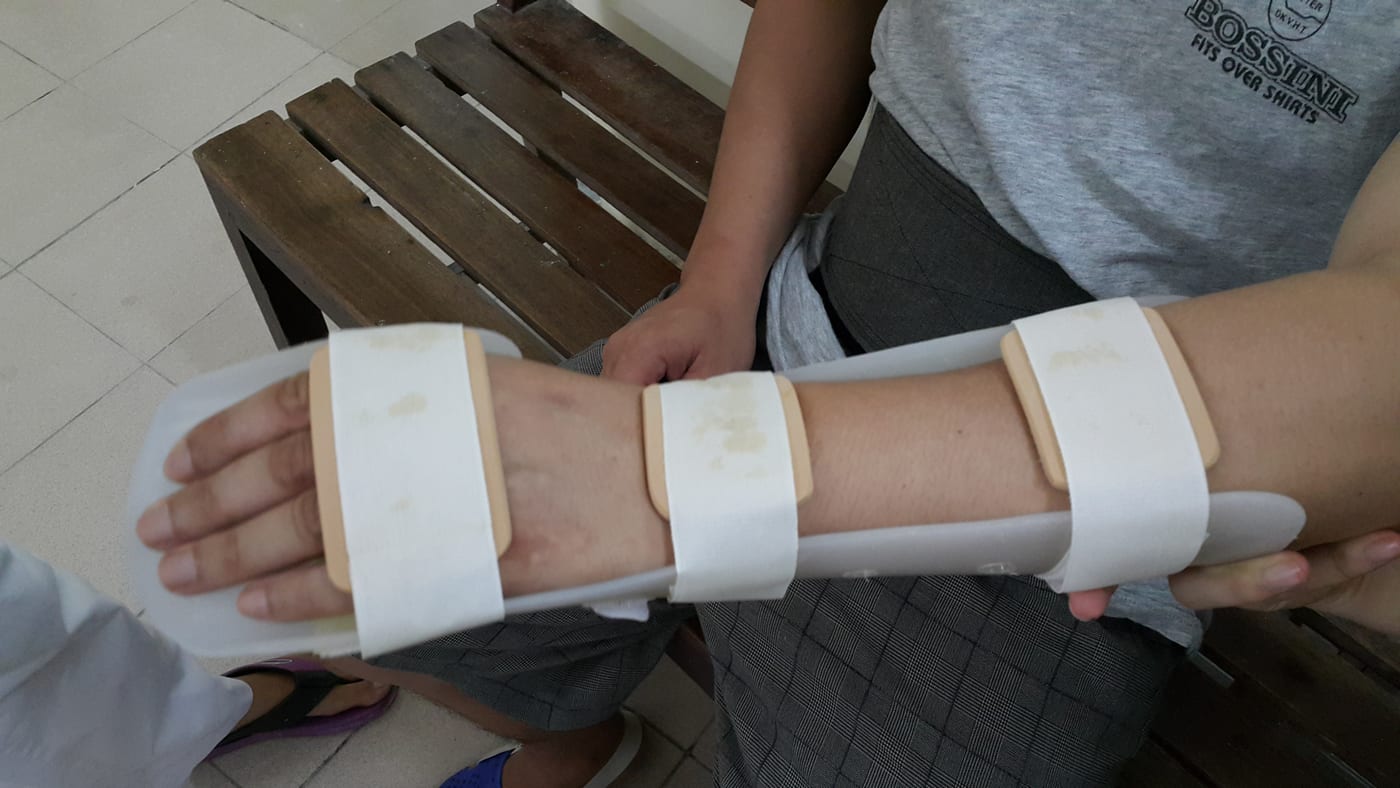Wrist–forearm orthosis with straps: immobilises, offloads and protects the wrist.