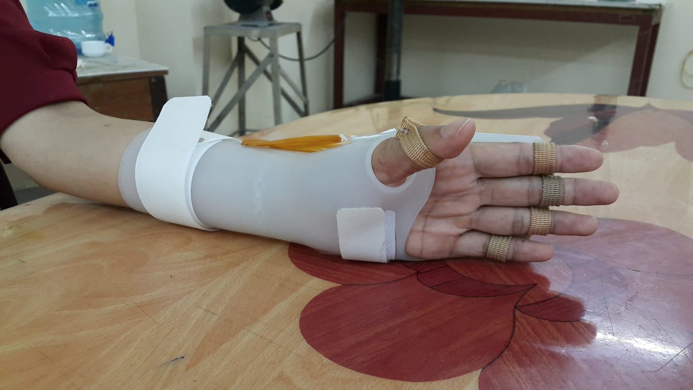 Wrist–hand orthosis: holds the wrist and fingers in a favourable position, supporting the hand in weakness, paralysis or after injury.