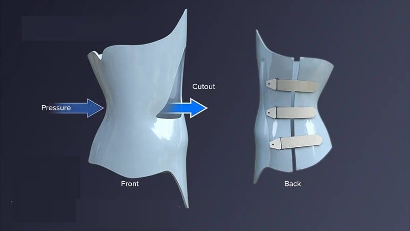 Brace principle: pressure areas and cut-out (relief) areas (source: dungcuchinhhinh.vn)
