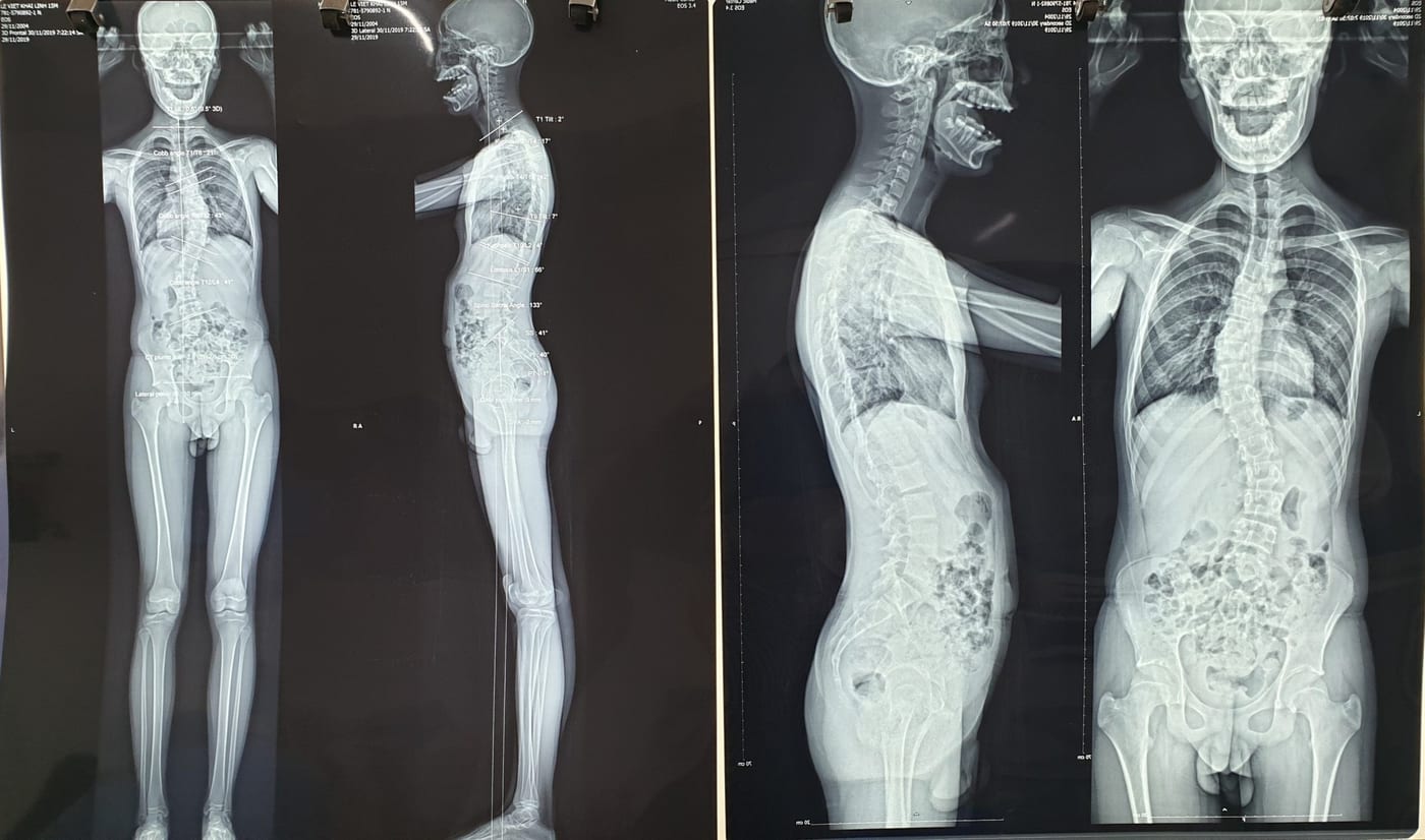 Full-length frontal and lateral X-rays of the case (source: dungcuchinhhinh.vn)