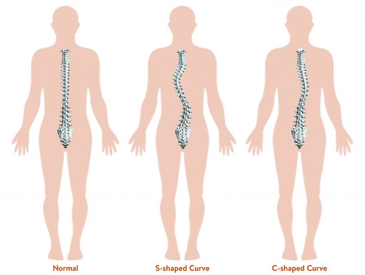 Scoliosis: bracing, tethering (VBT) or spinal fusion?